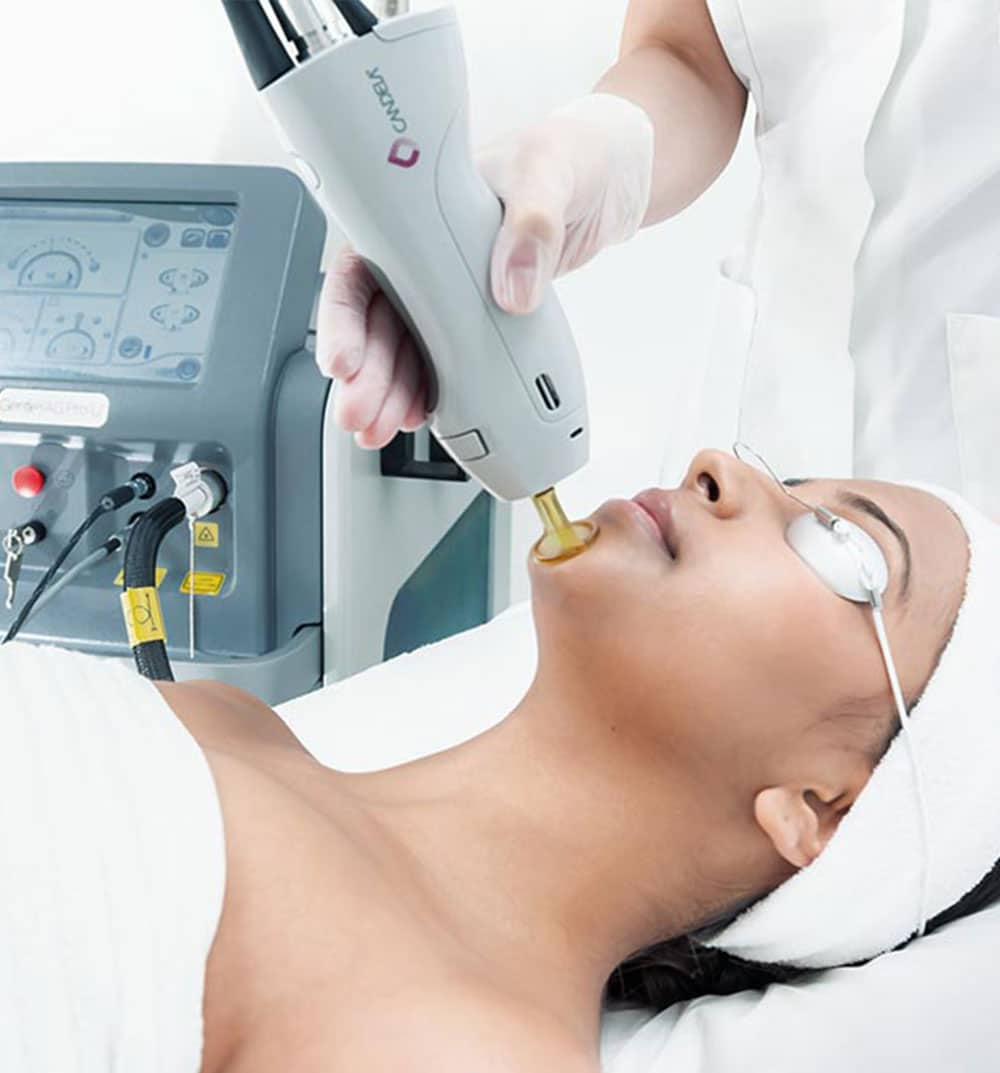 Candela device in clinic